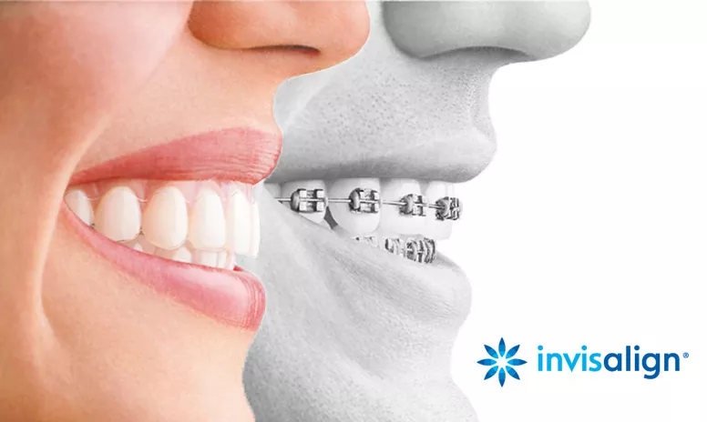 Ein strahlendes Lächeln - mit Invisalign Aligner